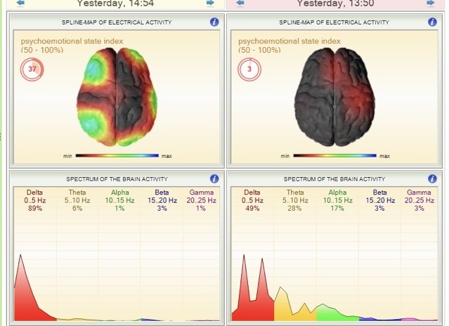 Third-party psychoemotional state biofeedback panel for one Carolina Regen client, before and after Mito2 sessions within a multi-modality wellness program. Individual experience, not a Mito2 outcome claim.