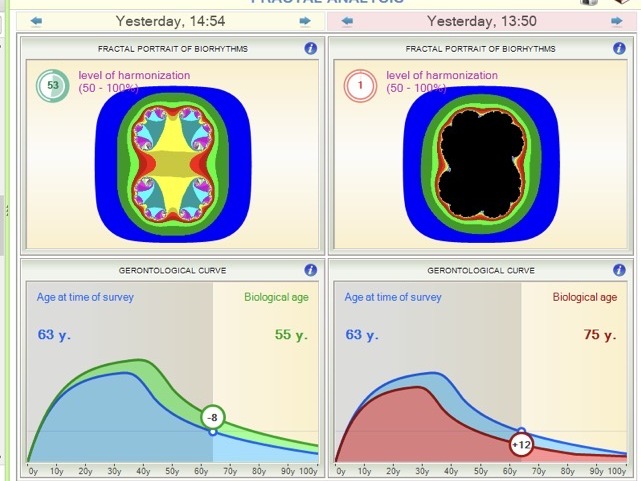Third-party fractal analysis biofeedback panel for one Carolina Regen client, before and after Mito2 sessions within a multi-modality wellness program. Individual experience, not a Mito2 outcome claim.